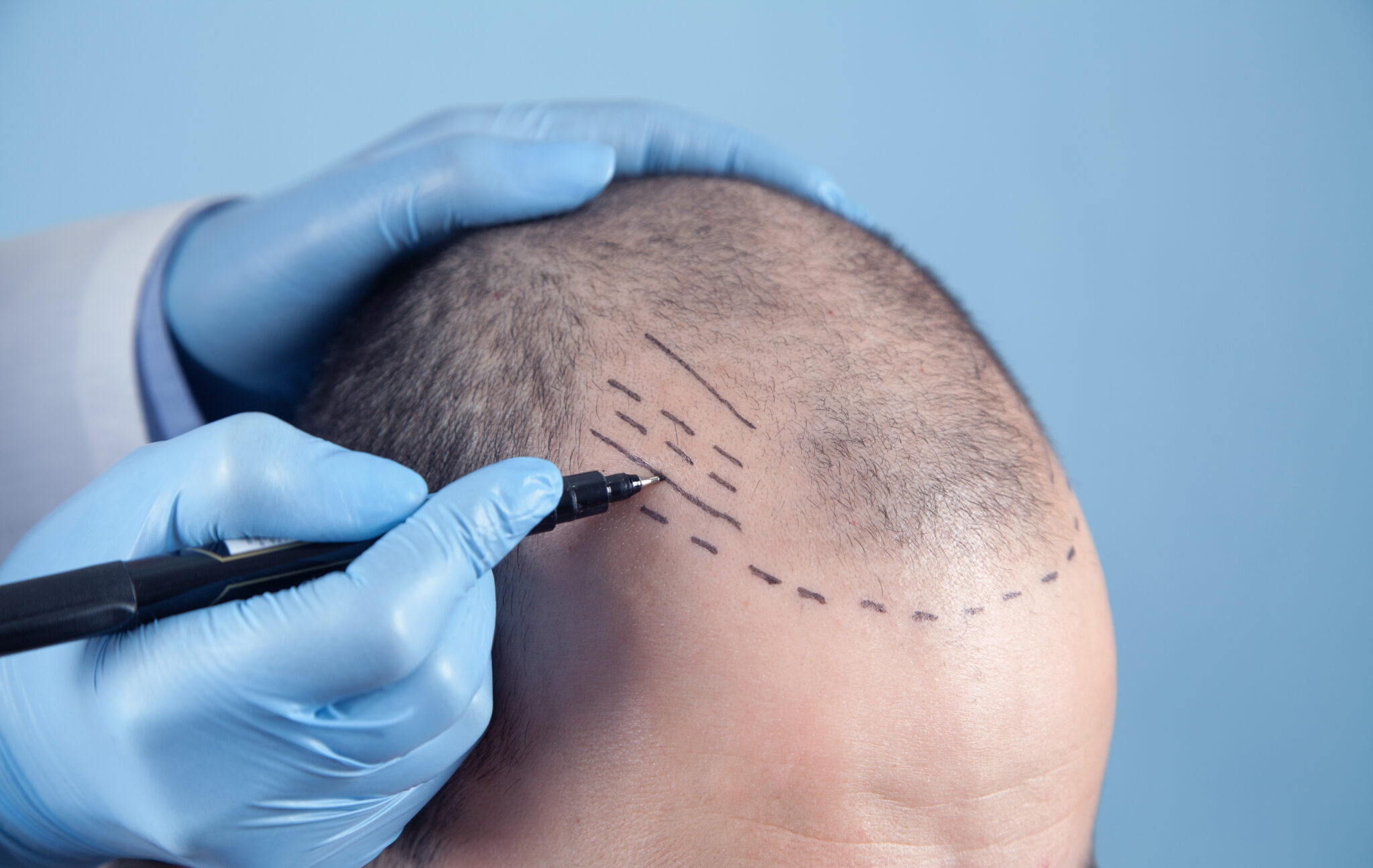 Crown Hair Transplant in Islamabad
