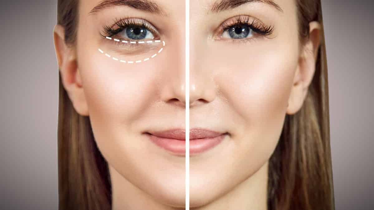 Eye Bag Removal in Islamabad