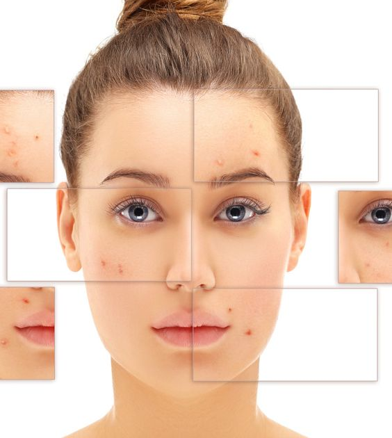 Laser Acne Treatment in Islamabad