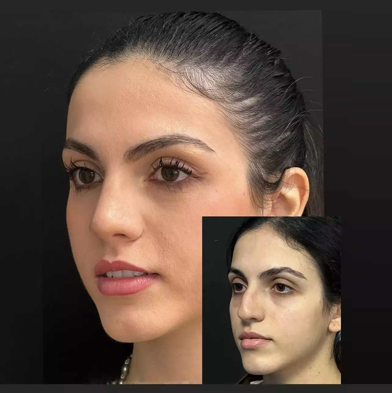 Rhinoplasty in Islamabad