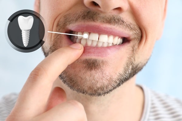Dental Implants in Islamabad